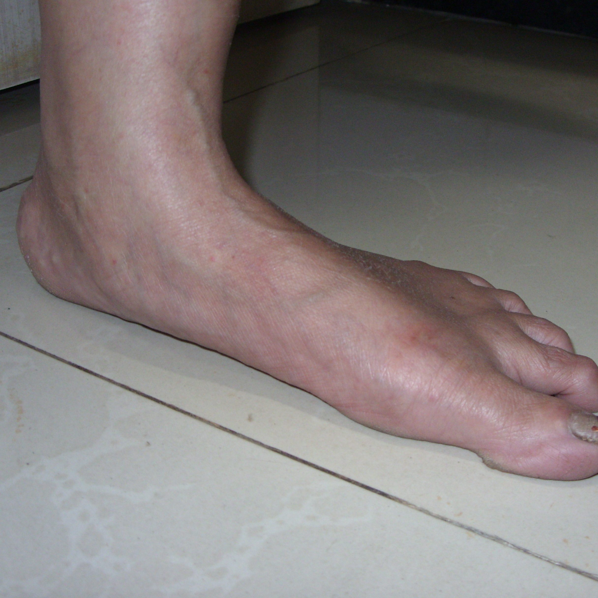 flat foot deformity